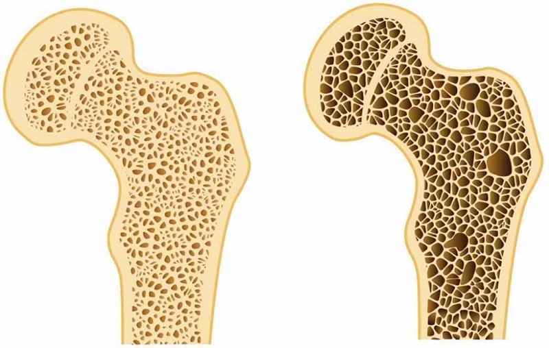 Khi thiếu vitamin D trầm trọng, kéo dài, sẽ làm giảm hấp thu canxi gây nhuyễn xương ở người lớn